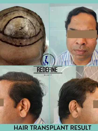 A successful hair transplant is a team effort. Here you can see the planning stage, where we map out the new hairline, and the final result. We ensure every graft is placed meticulously for a dense, natural look that lasts a lifetime.