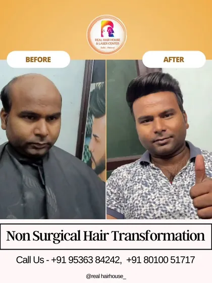 A happy client after his two-hour transformation. The goal was to restore a youthful hairline and add volume, and his positive reaction says it all. This is a completely non-surgical hair loss solution.