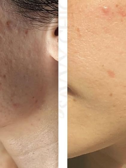 For patients with deep and pitted acne scars, the Fractional CO2 laser is a gold standard treatment. This before and after photo showcases the significant reduction in scar depth and improvement in skin texture that I can achieve.