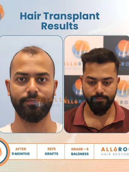 This 9-month result for a Grade 6 baldness case, achieved with 3875 grafts, is a testament to what is possible even in advanced stages of hair loss. The transformation is comprehensive and natural.