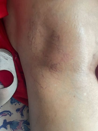 This is the leg after completing a course of our tailored physiotherapy. The improvement is clear, with a dramatic reduction in the appearance of the varicose veins.