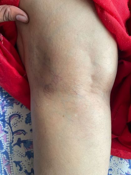 A final look at the successful outcome for Mrs. Bhavna, age 60. Our non-invasive techniques focus on improving blood flow and strengthening the leg to provide lasting relief from varicose veins.