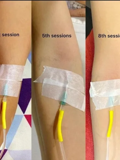 This series of images demonstrates the visible skin lightening results achieved with Glutathione drips over eight sessions. Offer your clients a proven path to brighter, more even-toned skin with the supplies we provide.