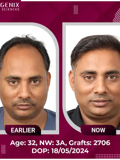 A 32-year-old patient's journey from Grade 3A baldness to a full, confident look after 2706 grafts.