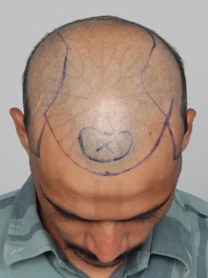 This shows the crucial first step: hairline design. We mark the area precisely to ensure the final result perfectly frames the face.