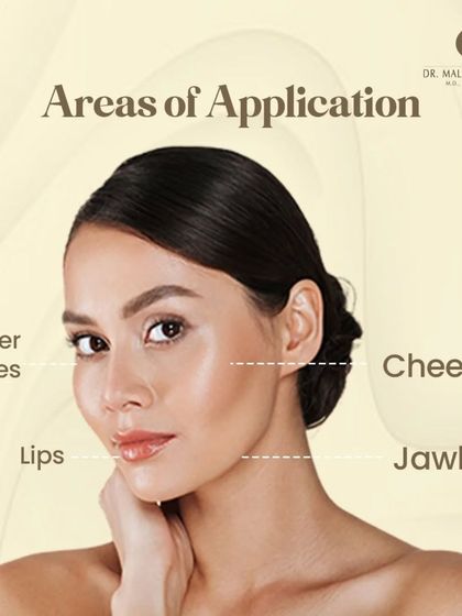 Dermal fillers can be applied to various areas of the face. Common treatment zones include the under eyes to reduce hollowness, the cheeks to restore volume, the lips for enhancement, and the jawline for definition.