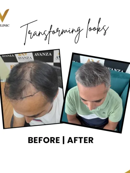 This before and after shows the hairline design markings and the final, grown-in result. We successfully restored the hairline and filled in the thinning top area.