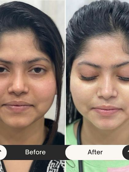 This before and after is a perfect example of the rejuvenating power of my Miracle Facial. Her skin looks brighter, smoother, and more rested. It's the perfect treatment to reset your skin and bring back its natural radiance.
