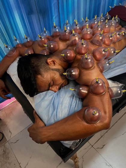 A full-back dry cupping session on a professional athlete. This extensive application helps to treat the entire posterior chain, relieving stiffness from the traps down to the lower back.