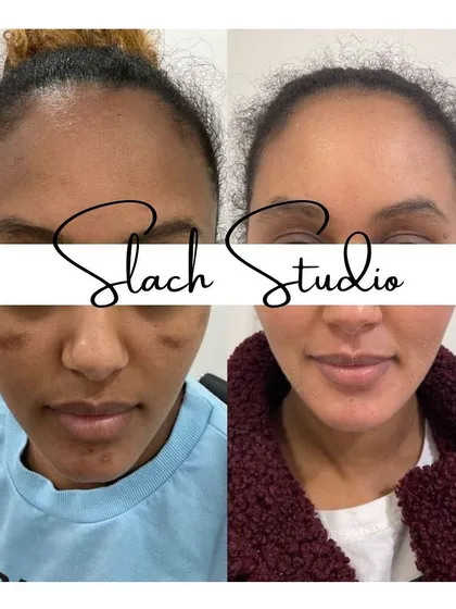 A client's journey from dealing with dark spots and uneven skin to a clear, bright complexion after her treatment.