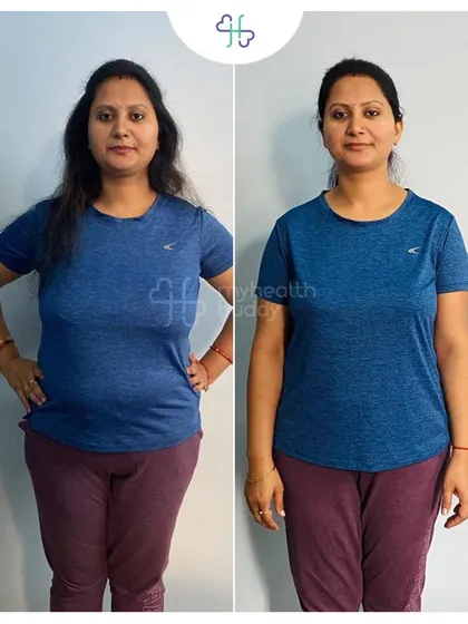 This is Rashmi, who lost an incredible 15 kg in just 3 months with me. Her transformation is a perfect example of what consistency with simple home workouts and a sustainable diet can achieve, especially after pregnancy.