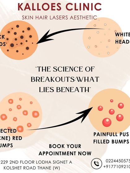 This graphic illustrates the science of a breakout, from a simple clogged pore (blackhead or whitehead) to an inflamed red bump and a painful, pus-filled lesion. Understanding this process helps you understand why medical treatment is necessary.