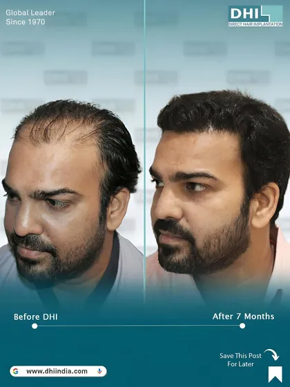 A side-view comparison showing a client's 7-month progress. The restored hairline and temple points create a more youthful and defined facial frame, a hallmark of our artistic approach to hair restoration.