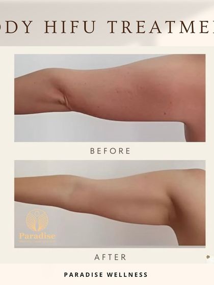 HIFU isn't just for the face. This before and after shows the incredible results of Body HIFU after 6 sessions on sagging arms, resulting in a firmer, more sculpted appearance.