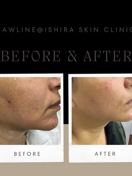 A well-defined jawline can transform your entire profile. Here, I used dermal fillers to sculpt the jawline and correct drooping at the corners of the mouth, creating a sharper and more youthful contour.