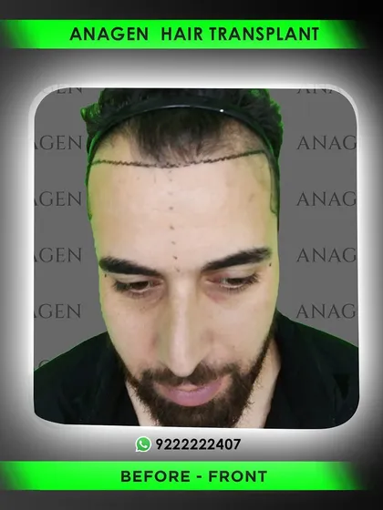 A frontal view of the hairline design before the procedure. This meticulous planning is crucial for achieving a natural and aesthetically pleasing result that suits the patient's facial structure.
