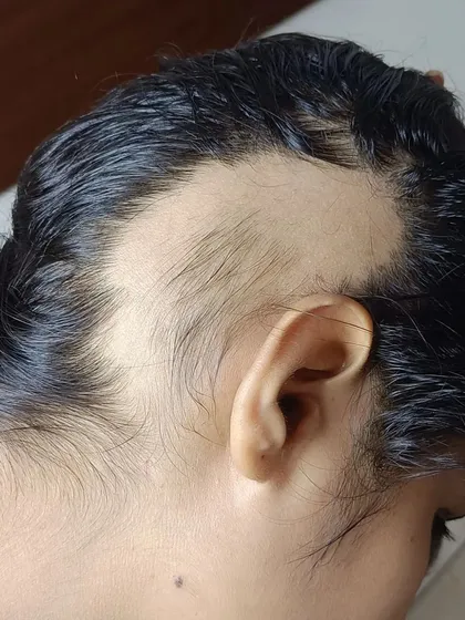 Alopecia Areata can affect anyone at any age, causing distinct bald patches as seen here. With the right diagnosis and treatment plan, it is possible to manage the condition and encourage hair regrowth.