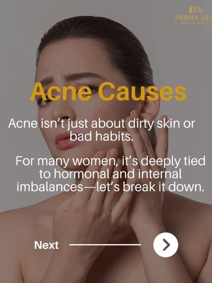 An infographic explaining that acne isn't just about bad habits; for many women, it's tied to hormonal and internal imbalances.
