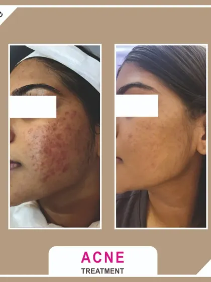 This client was struggling with active acne and post-inflammatory marks. A series of specialized chemical peels helped clear the breakouts and fade the discoloration for much clearer skin.