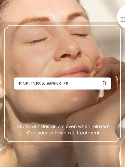 Are your wrinkles visible even when your face is relaxed? These are called static wrinkles, and they are a sign that it might be time to consider an anti-wrinkle treatment to smooth and soften your skin.