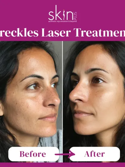 A compelling before-and-after of a freckle laser treatment. This image effectively demonstrates my ability to use advanced laser technology to safely and precisely reduce pigmentation and sun spots for clearer skin.