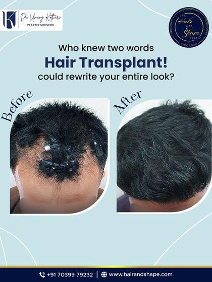 A simple before and after that shows the power of a hair transplant to rewrite your entire look, restoring hair to the crown.