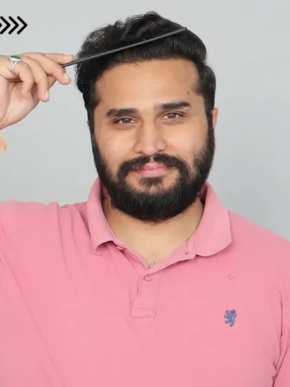 One year transformation for a Diffuse Grade 6 case. We rebuilt the entire top section with 5500 grafts in a single session.