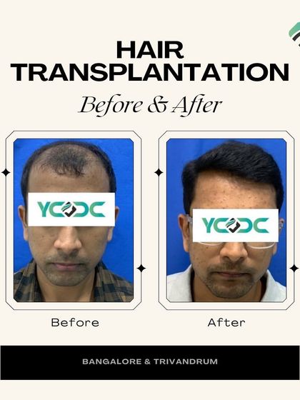 Creating natural hairlines is my specialty. This transformation highlights how a carefully planned FUE procedure can completely rejuvenate a person's look.