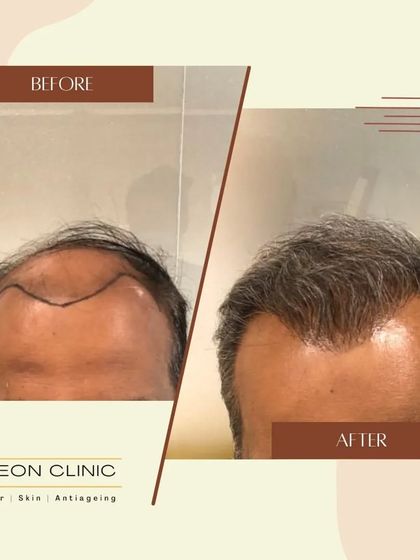 A clear before-and-after of a hairline reconstruction. We focus on creating a soft, natural edge for a result that doesn't look transplanted.