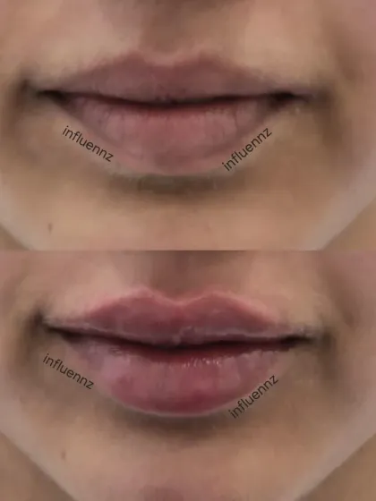 Here you can see how we've added volume and definition with lip fillers. The result is a plumper, more hydrated appearance that still looks completely natural.