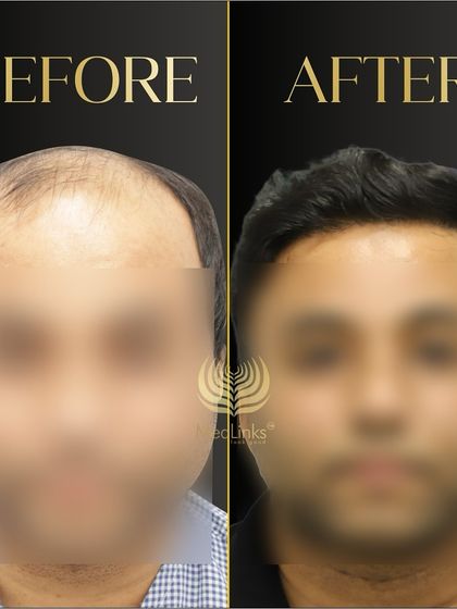 A before and after shot with the patient's face blurred for privacy. The focus is on the hair, which shows a remarkable improvement in density and coverage.