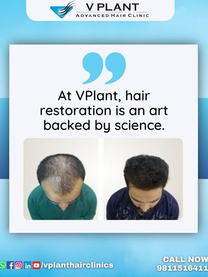 At Vplant, hair restoration is an art backed by science. This top-down before-and-after view shows the artistic placement of grafts leading to a natural and full result.