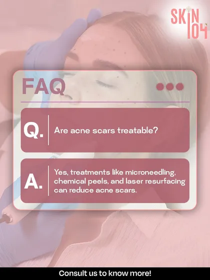 Frequently Asked Question: Are acne scars treatable? Yes, they are. We offer effective solutions like microneedling, chemical peels, and laser resurfacing to significantly reduce their appearance.