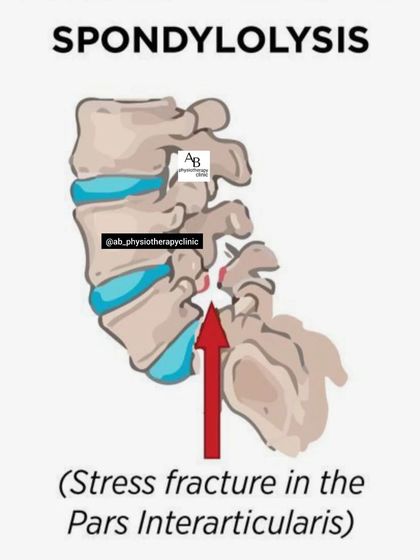 This image illustrates Spondylolysis, a stress fracture in a vertebra that is a common cause of lower back pain, especially in young athletes. Early diagnosis and physiotherapy are key to preventing it from worsening.