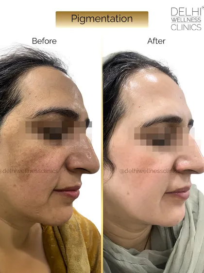 This image captures the progress from another angle, showing how the pigmentation has faded to reveal a healthier and more even complexion.