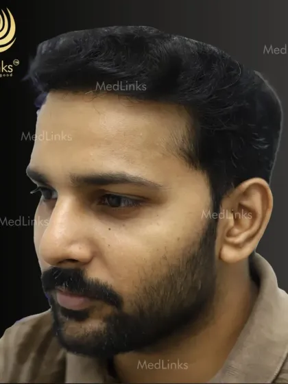 The same patient, post-transplant. The new hairline is soft and natural, blending perfectly with his facial features for a subtle but powerful enhancement.