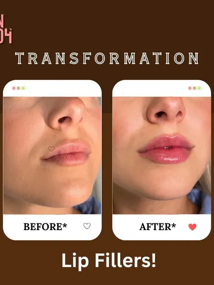 See the beautiful, natural-looking transformation our lip fillers can provide. This before and after showcases how we add subtle volume and definition for a perfectly plump and hydrated pout.