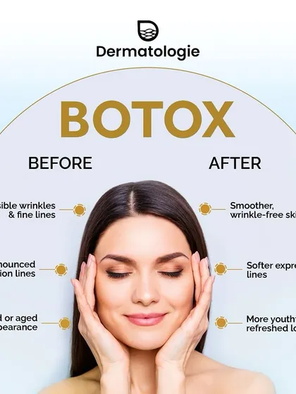 Botox is a highly effective tool for achieving a more rested and youthful appearance. This graphic shows the clear transition from visible expression lines to smoother, wrinkle-free skin, highlighting its ability to soften features naturally.