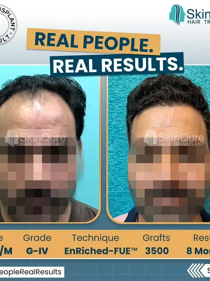 For this 35-year-old patient with Grade IV hair loss, we implanted 3500 grafts. The 8-month 'after' photo shows a significant improvement in coverage and a well-defined, natural hairline that looks completely his own.