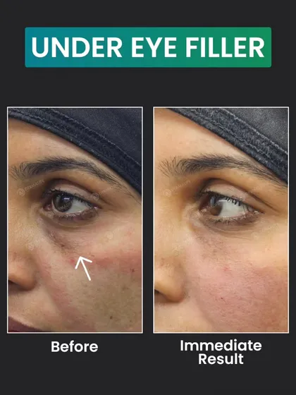 This image clearly shows the result of an under-eye filler from a different angle. You can see how the treatment has smoothed the contour and reduced the shadow, leading to an immediate and natural-looking refreshment.