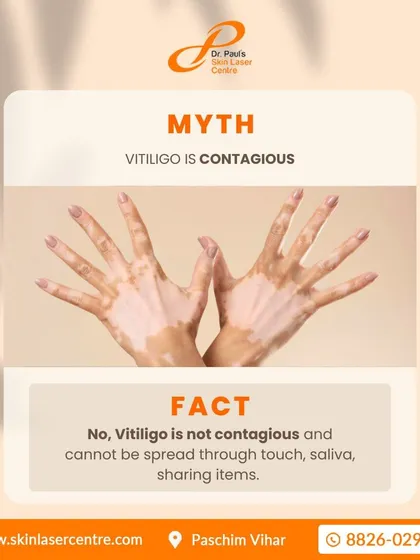It is very important to understand that vitiligo is not contagious. You cannot get it from touching someone, sharing items, or through any other form of contact. Spreading facts helps us overcome the social stigma associated with the condition.