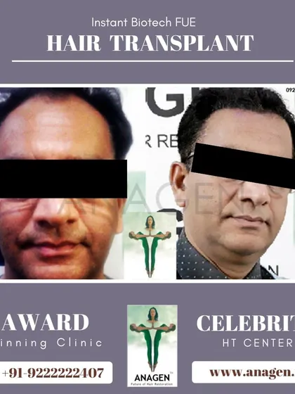 An excellent result from our Instant Biotech FUE hair transplant. This before and after image shows a significant improvement in hair density and overall appearance.