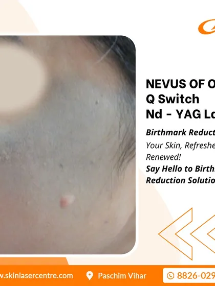 This shows a case of Nevus of Ota, a type of birthmark, which I treat with a Q-Switch Nd-YAG Laser. This advanced treatment is designed to refresh and renew the skin by reducing such pigmentation.