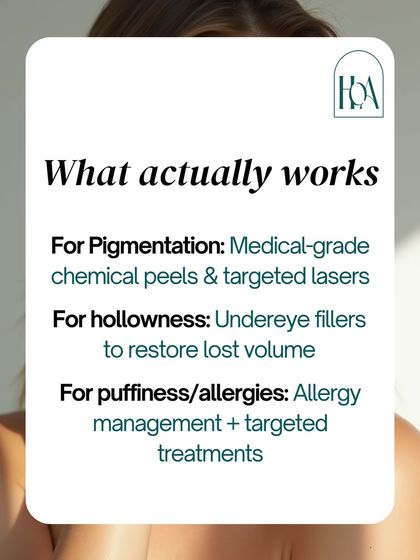 So what actually works for dark circles? For pigmentation, we use medical-grade peels and lasers. For hollowness, under-eye fillers restore volume. For puffiness from allergies, we manage the root cause with targeted treatments.