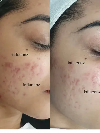 Those stubborn red marks left after a pimple heals are called post-acne erythema. This is not scarring but inflammation. I use targeted treatments to specifically calm this redness and speed up the healing process, ensuring your skin tone becomes even and clear.