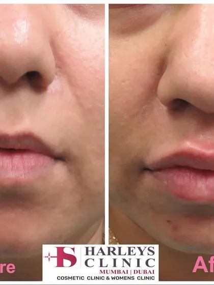 This before and after shows how I use hyaluronic acid fillers for subtle lip enhancement. My goal is to add volume and definition that complements your natural facial structure, resulting in a refreshed and balanced appearance, not an overdone look.