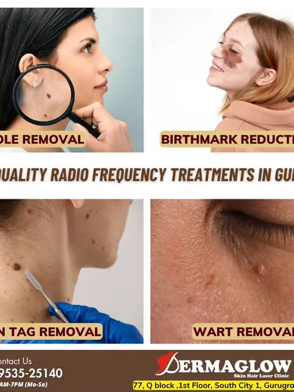 We offer a comprehensive solution for various skin concerns. This collage shows the four main types of blemishes we treat: moles, birthmarks, skin tags, and warts, all addressed with our advanced radiofrequency technology.