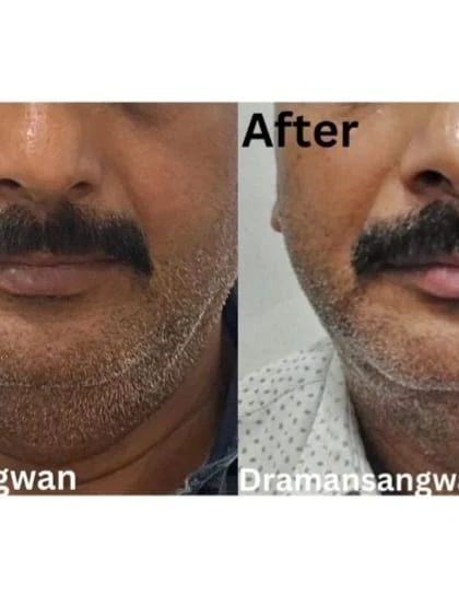 This before-and-after demonstrates the effectiveness of fat lysis injections for reducing a double chin. The 'after' image shows a more contoured and defined jawline, achieved through a non-invasive procedure.