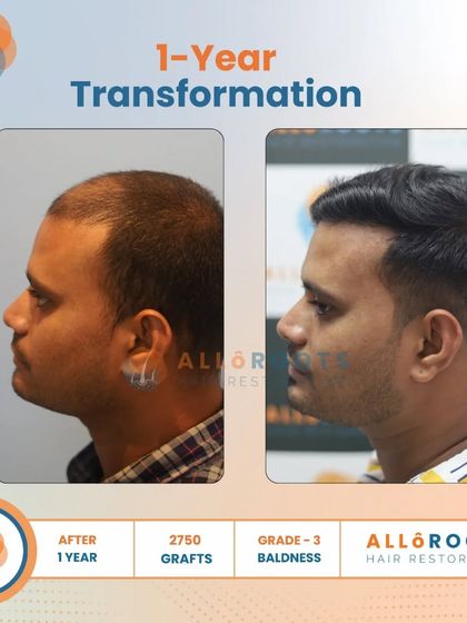 This one-year transformation for a Grade 3 baldness case was achieved with 2750 grafts. The series of photos demonstrates the significant improvement in density and hairline from every angle.