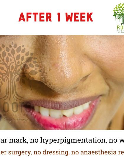 Just one week after a single session of Agnikarma, the mole has disappeared completely, leaving behind smooth, healing skin.